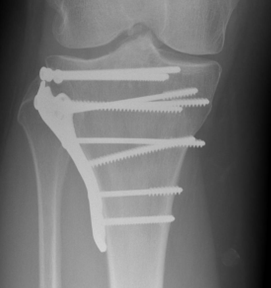 Tibial Plateau ORIF